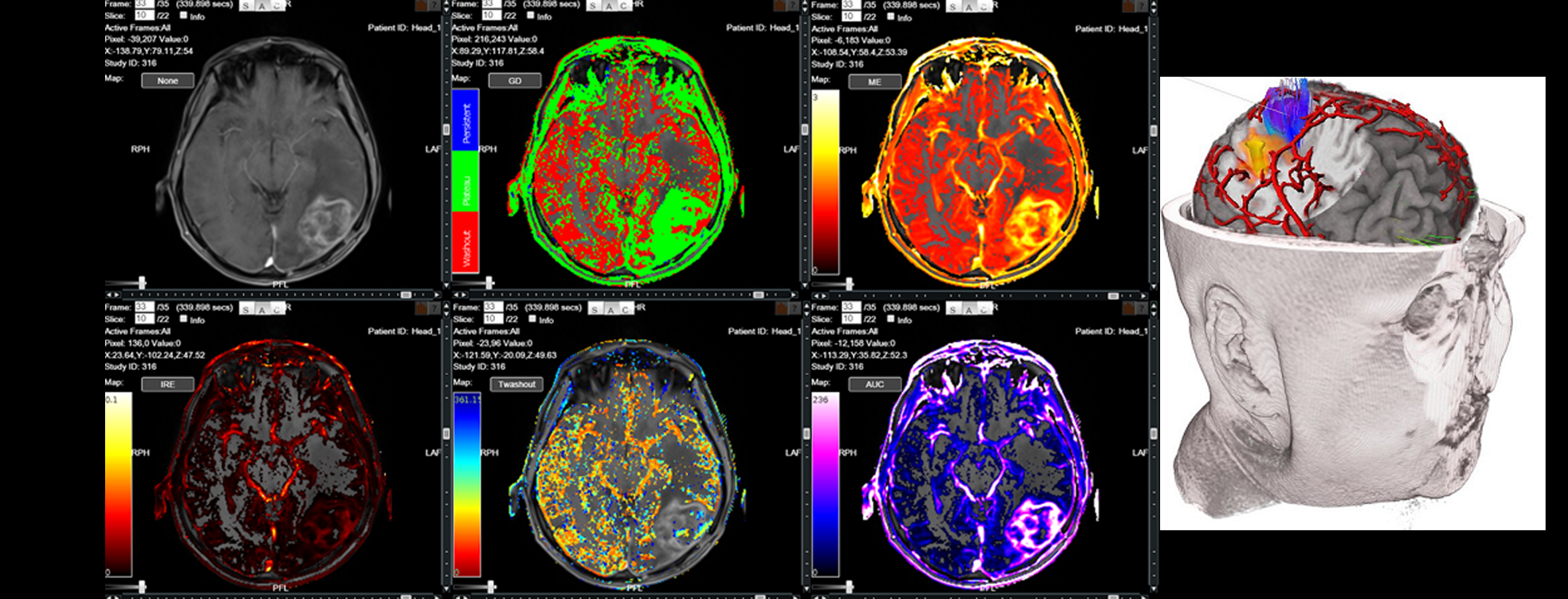 Banner-GLIOBLASTOMA