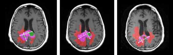 Longitudinal-Image-GBM