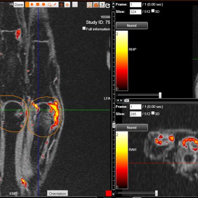 Banner-RHEUMATOID-ARTHRITIS