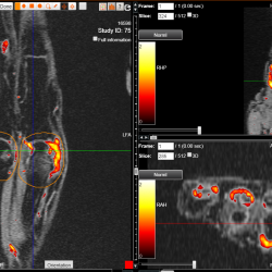 Reducing Length & Cost of Trials through Patient Stratification