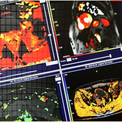 prostate-heart