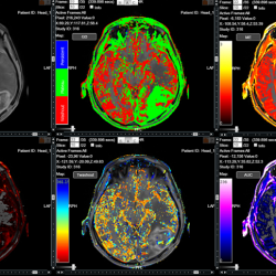 Glioblastoma-IAG