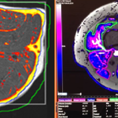 Muscle-MRI