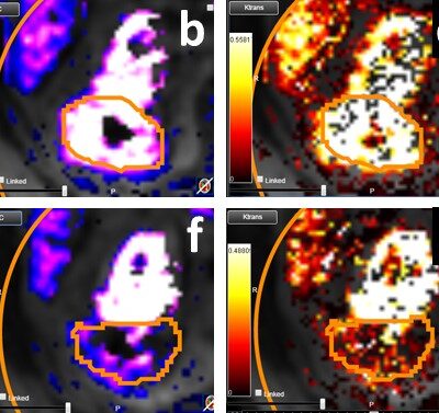 The image above is allustrating DCE MRI maps of a treatment responder pre-SABR (a-d) and post-SABR (e-h) including (left-right) IRE, AUC, Ktrans and Ve with tumour outlined in orange, generated with Dynamika [4]. The corresponding slice between pre-SABR and post-SABR scans.