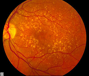 300px-Intermediate_age_related_macular_degeneration