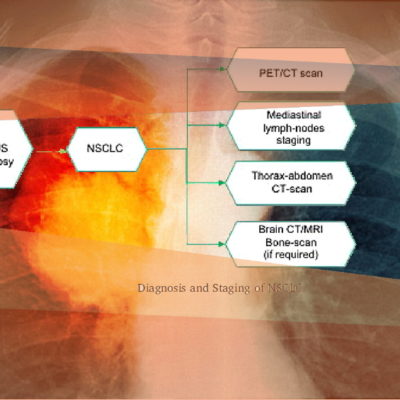 Lung cancer