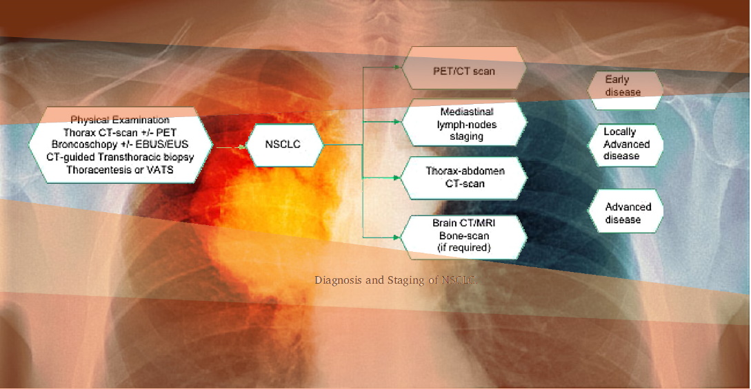 LUNG CANCER | IAG