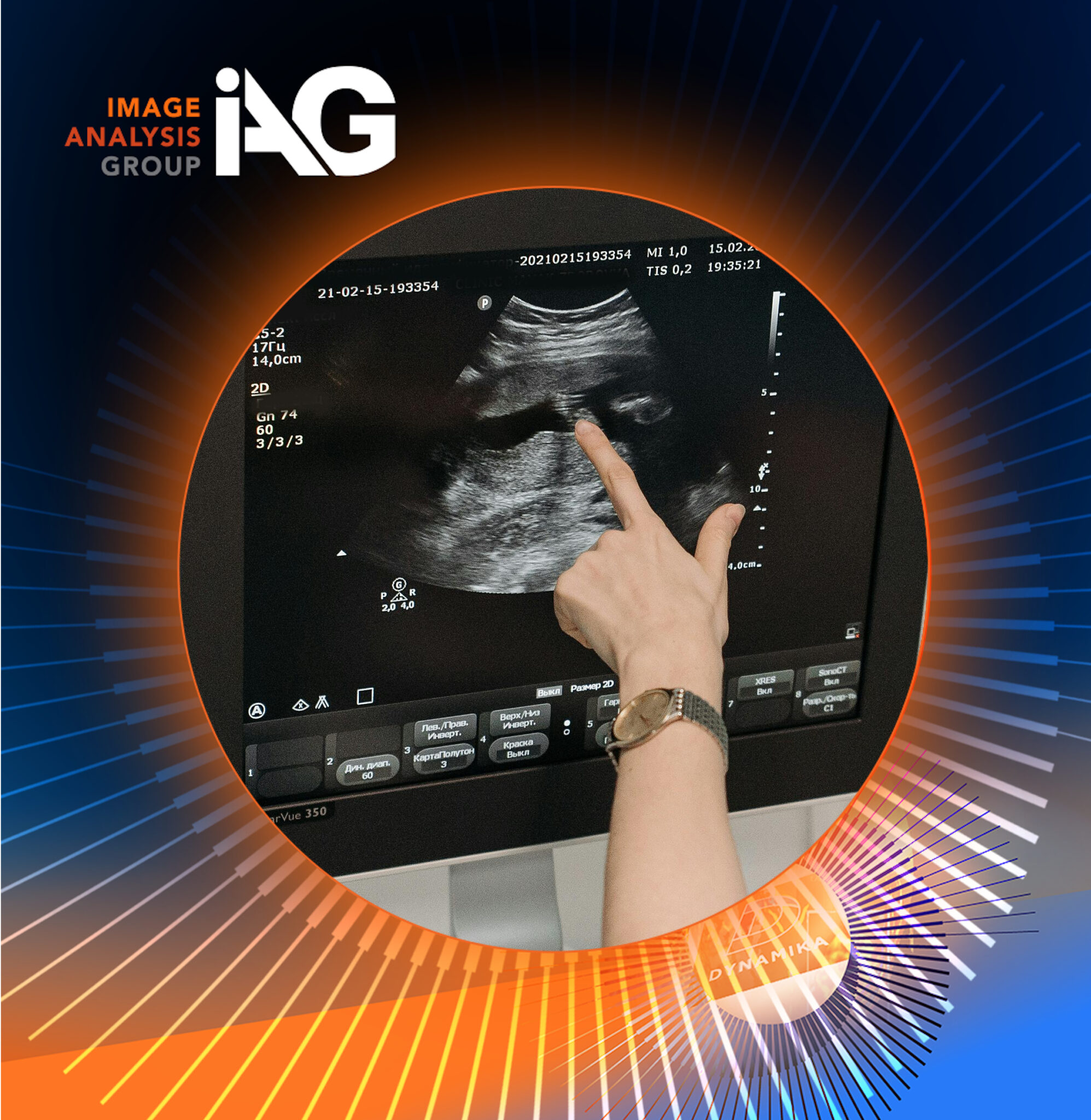 Ultrasound fertility imaging with AI biomarkers visualisation for Image Analysis Group and Ferring collaboration