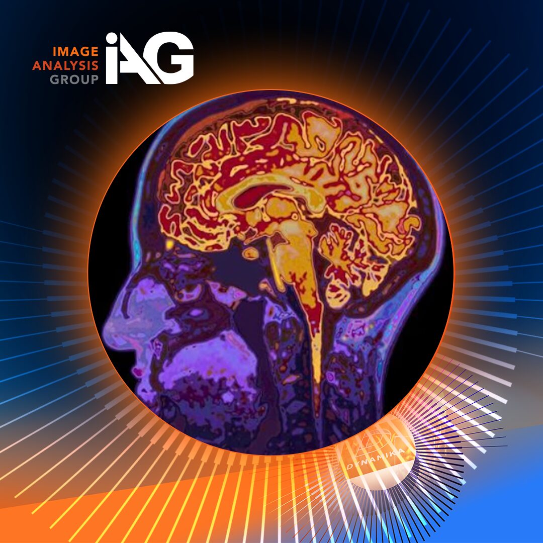 Brain MRI scan for autoimmune disease research.