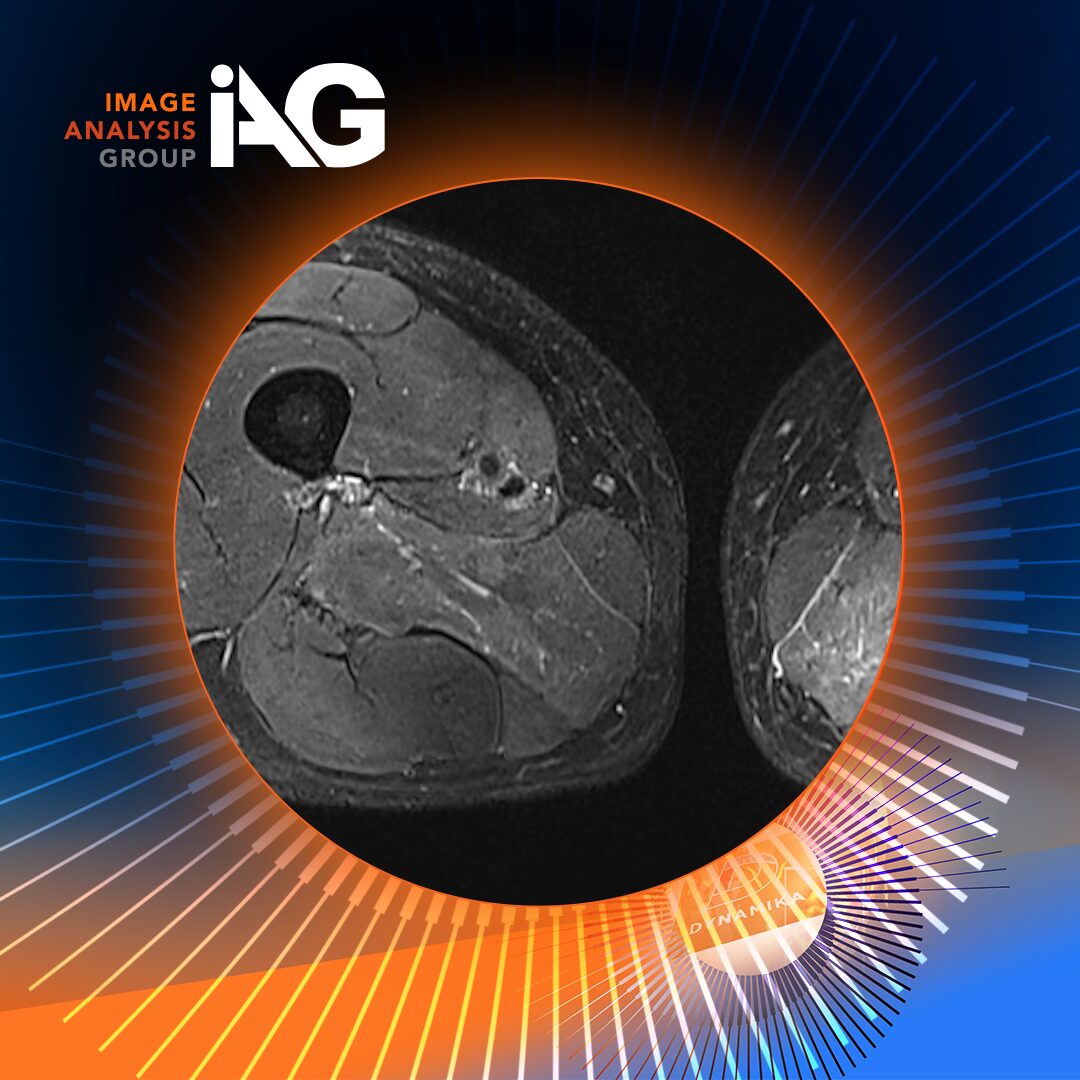 MRI of thigh muscles showing inflammatory changes used in IAG clinical trial imaging for CAR‑T autoimmune therapies.