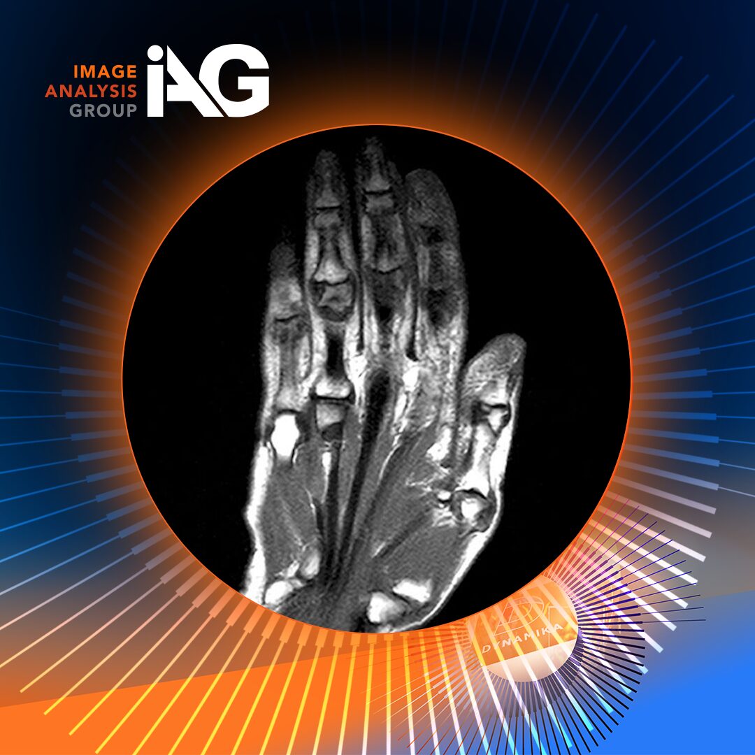 MRI hand imaging and DYNAMIKA™ branding illustrating DAVIX MRI biomarker in systemic sclerosis clinical trials.