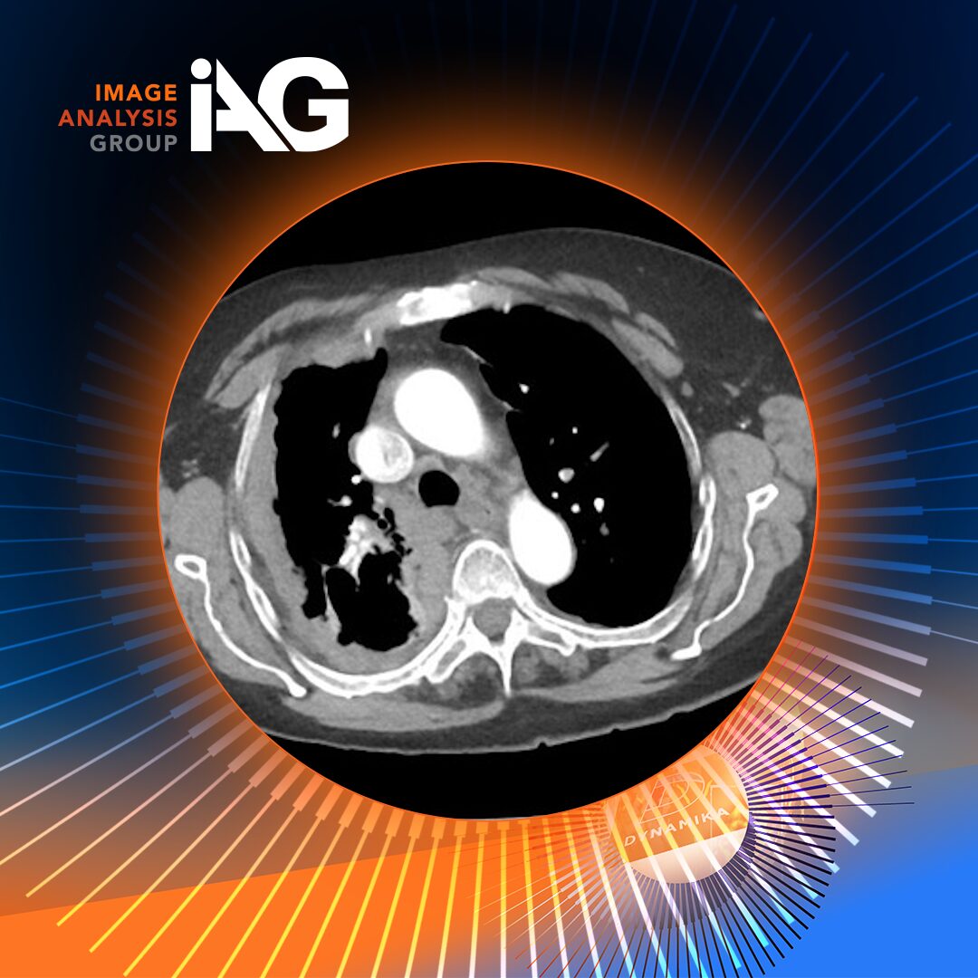 CT chest scan showing malignant pleural mesothelioma rind-like pleural thickening used to assess treatment response in mesothelioma drug development imaging studies.