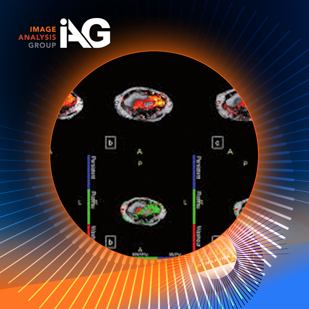 Arthritis clinical trials using quantitative DCE-MRI imaging to measure synovitis and inflammation in the knee joint.
